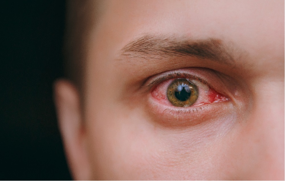kötőhártya gyulladás tünetei, piros szem