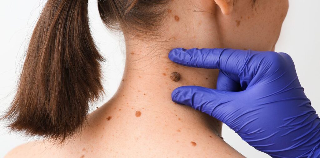 Mikortól kell eltávolítani az anyajegyet?